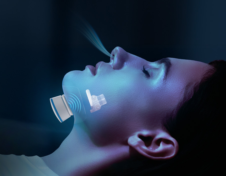 Genio for Sleep Apnea
